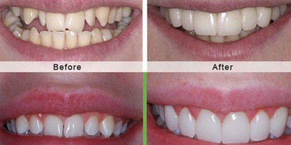 Lựa chọn cơ sở bọc răng sứ an toàn để có được giá trị sử dụng lâu