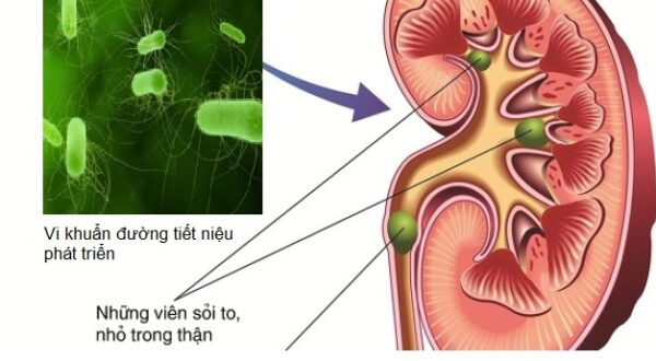 Nguyên nhân gây nhiễm trùng đường tiết niệu