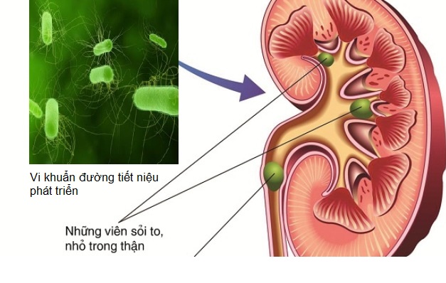 Nguyên nhân gây nhiễm trùng đường tiết niệu