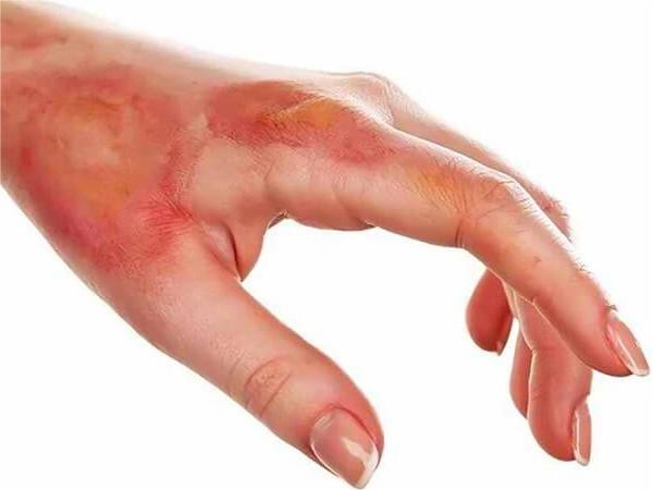 Cách xử lý axit nitric tiếp xúc với da