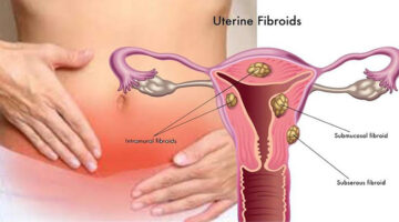 Bệnh phụ khoa thường gặp