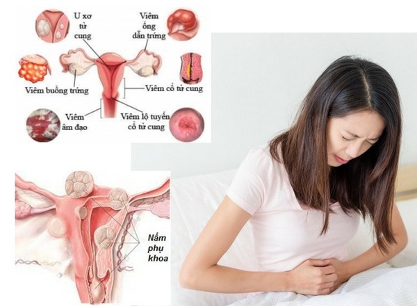 Dấu hiệu nhận biết viêm nhiễm phụ khoa