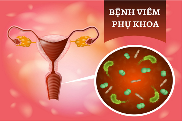 Viêm phụ khoa ở nữ giới
