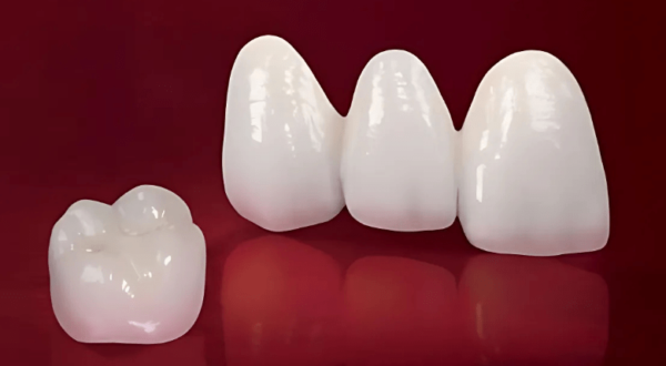 Quy trình bọc răng toàn sứ