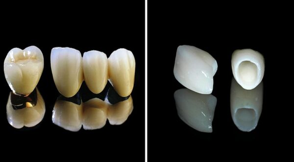 Răng toàn sứ cao cấp