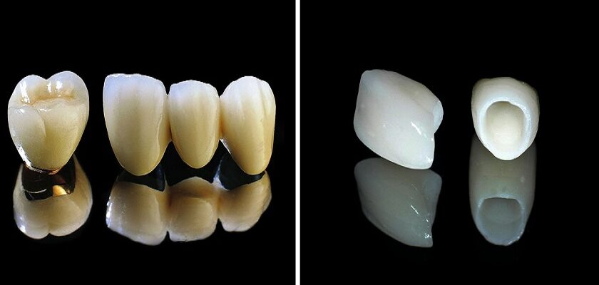 Răng toàn sứ cao cấp