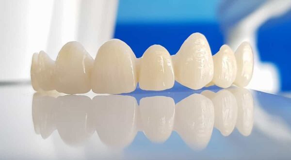 Các loại răng sứ phổ biến 