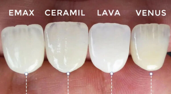 Các dòng răng sứ cao cấp phổ biến
