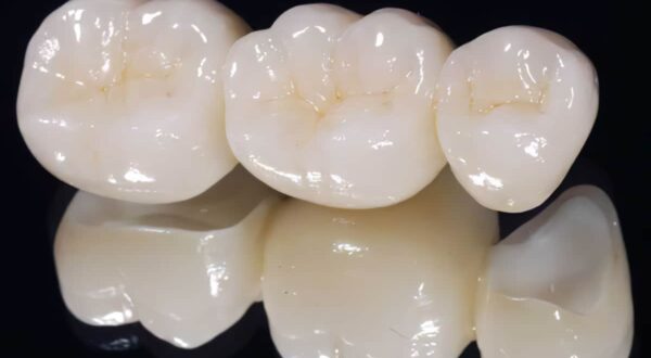 Răng sứ không kim loại