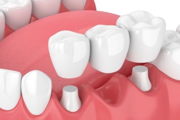 Tổng quan về cầu răng sứ kim loại phổ biến