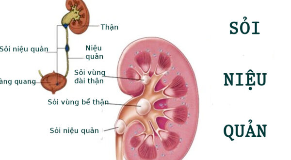 Sỏi tiết niệu