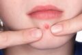 Có nên nặn mụn viêm không và trường hợp nào cần tránh