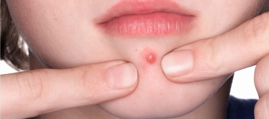 Có nên nặn mụn viêm không và trường hợp nào cần tránh