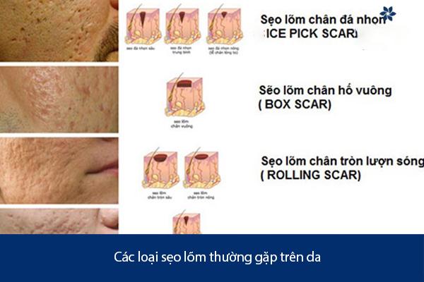 Da xuất hiện sẹo lõm sau mụn viêm