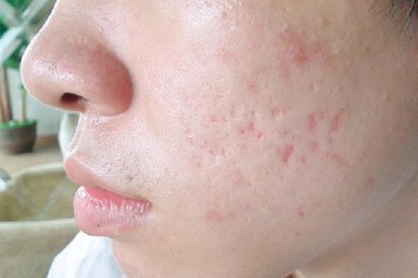 Tình trạng sẹo rỗ hình thành từ mụn viêm
