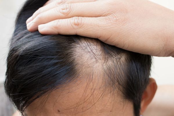 Cách kích thích mọc tóc ở trán