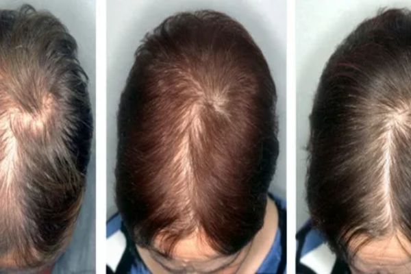 Tóc thưa và ảnh hưởng đến ngoại hình